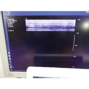 AIXPLORER® scanner de ultra-sons