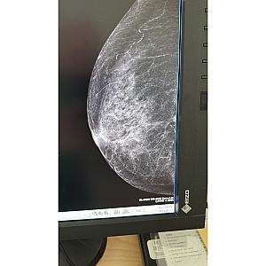 Mamógrafo Senographe Pristina 3D
